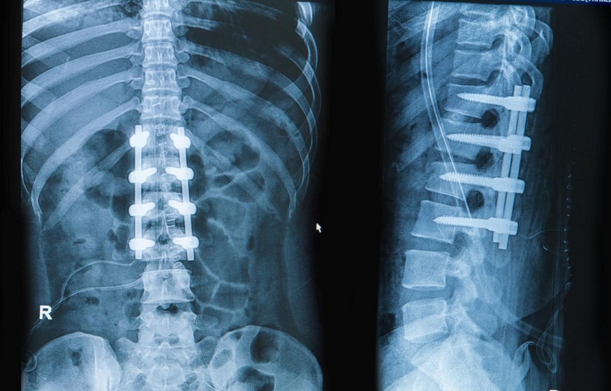 Leveraging AI to Predict Long-Term Success of Spinal Implants